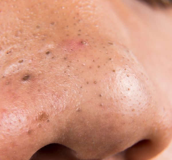 Blackheads | Whiteheads