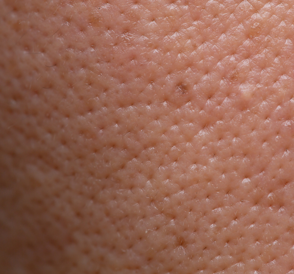 Enlarged Pores