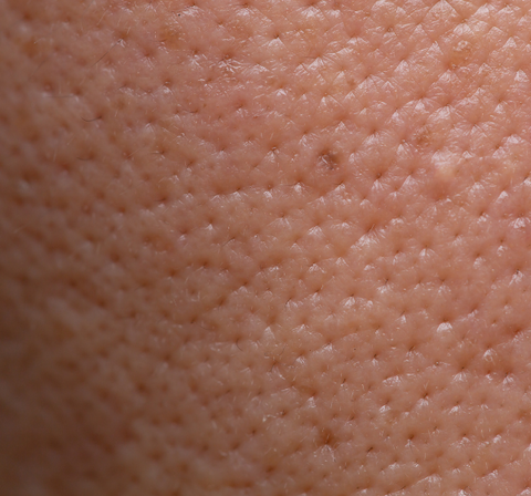 Enlarged Pores